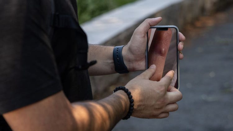 monkeypox viral disease